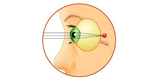 болезни глаз дальнозоркость